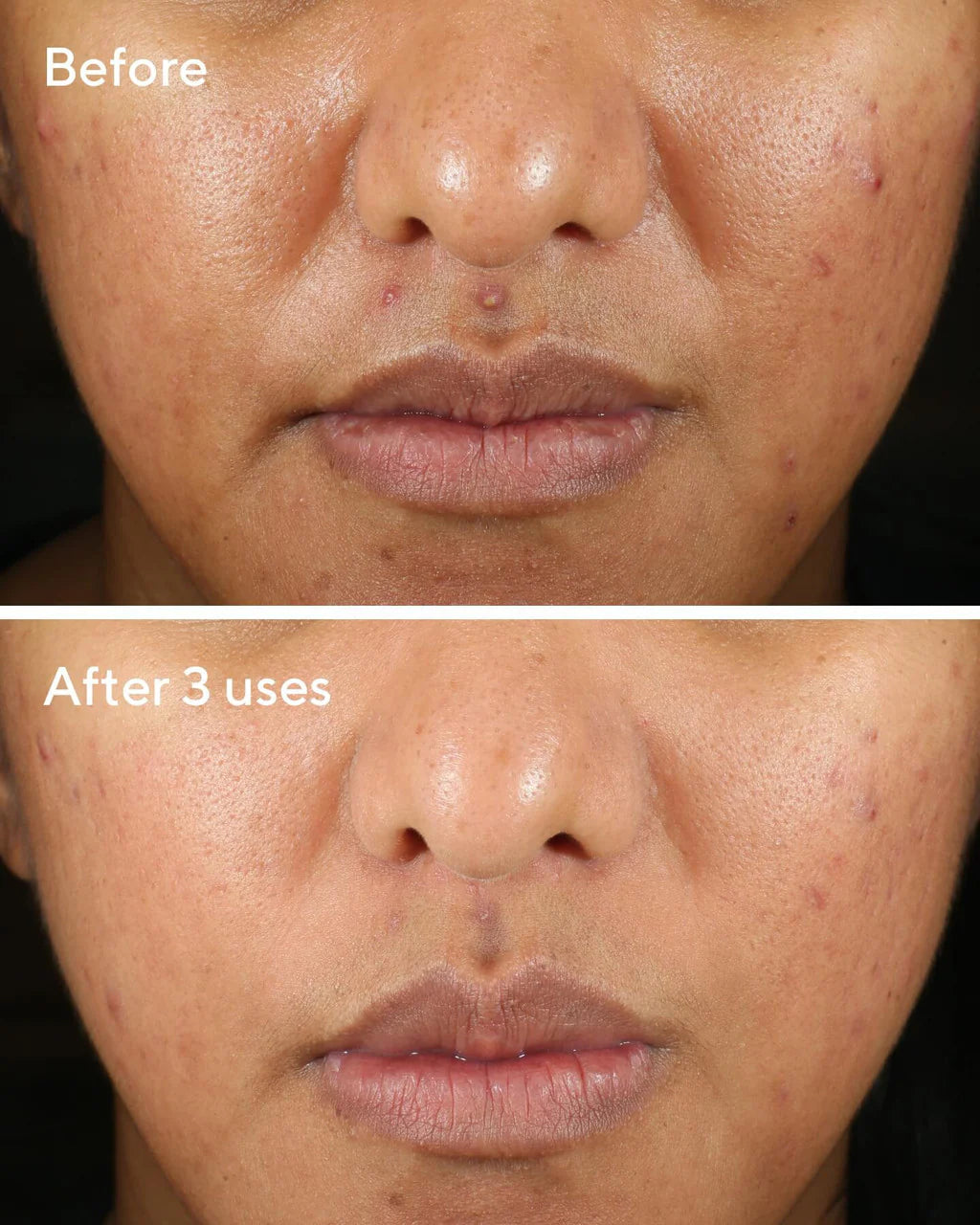 Murad Rapid Relief Acne Sulfur Mask ماسك الكبريت للعلاج السريع للحبوب والرؤوس السوداء