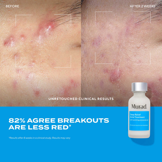 Murad Deep Relief Acne Treatment علاج مركز للحبوب العميقة والمؤلمة