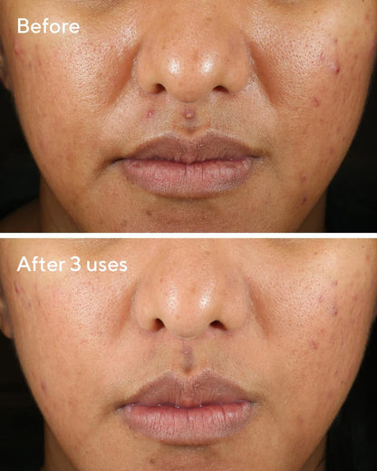 Murad Rapid Relief Acne Sulfur Mask ماسك الكبريت للعلاج السريع للحبوب والرؤوس السوداء