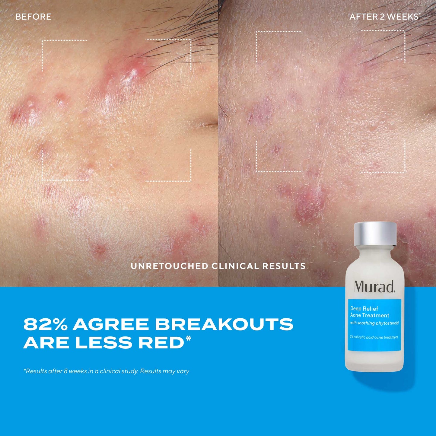 Murad Deep Relief Acne Treatment علاج مركز للحبوب العميقة والمؤلمة