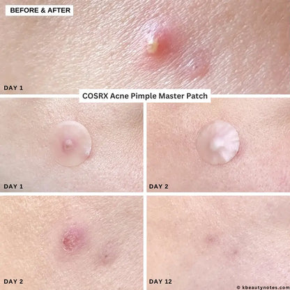 Cosrx Acne Pimple Master Patch, 24 Patches