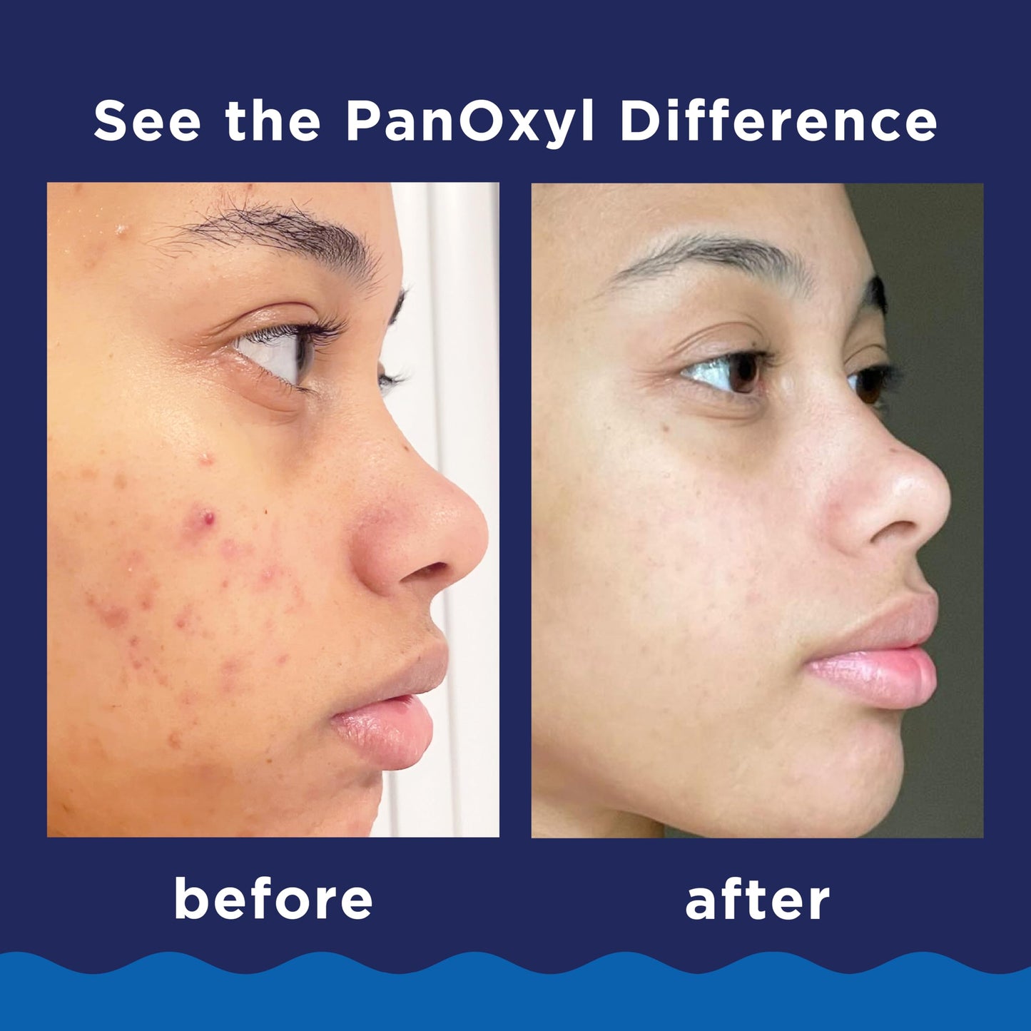 PanOxyl Acne Foaming Wash Benzoyl Peroxide 10% Maximum Strength Antimicrobial