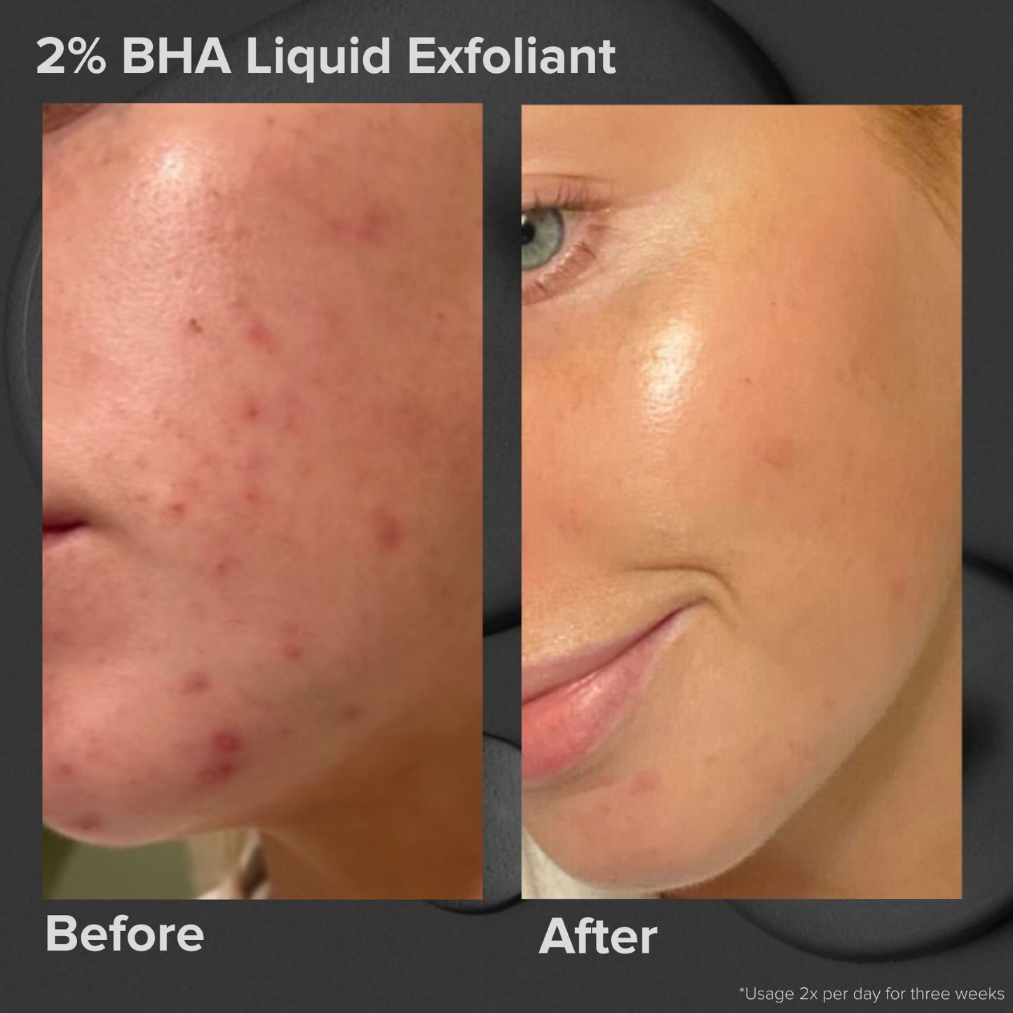 Paula’s Choice Skin Perfecting 2% BHA Liquid Exfoliant