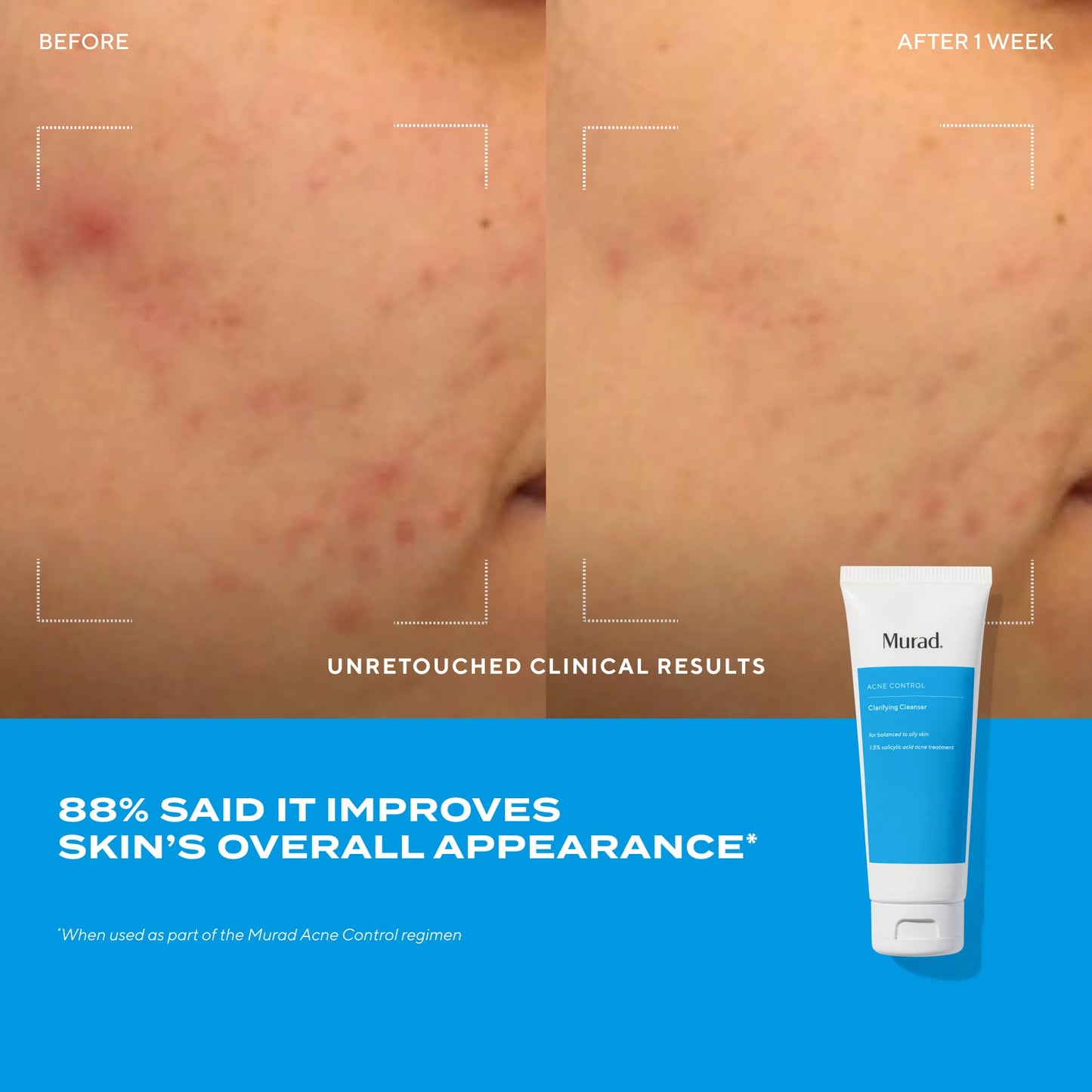 Murad Clear Skin Acne Discovery Kit مجموعة اكتشاف العناية بالبشرة المعرضة لحب الشباب