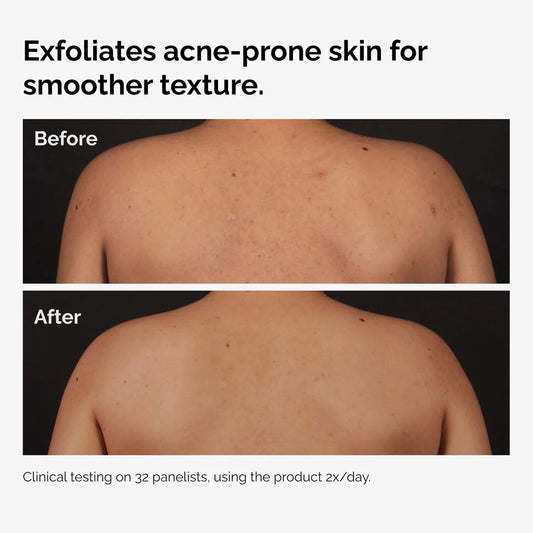 The Ordinary Salicylic Acid 0.5% Body Serum  سيروم الجسم بحمض الساليسيليك 0.5% لعلاج حب الشباب