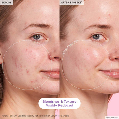 Glow Recipe  Blackberry Retinol Blemish Serum