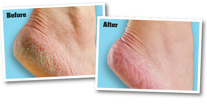 Healthy Feet FOOT CREAM for extremely dry, cracked feet