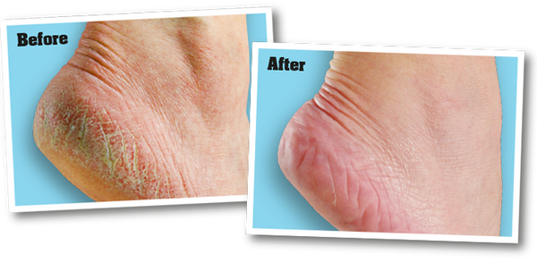 Healthy Feet FOOT CREAM for extremely dry, cracked feet